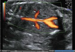 兩側腎動脈 Renal arteries